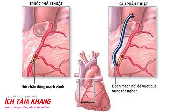 Phẫu thuật bắc cầu động mạch cho người bệnh mạch vành
